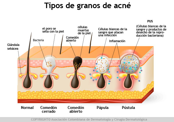 esquema granos de acné